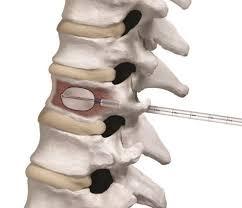 Vertebral Augmentation Procedures